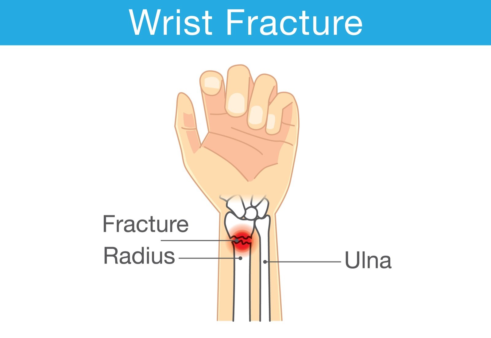 How Much Force Does It Take To Break A Wrist   Distal Radial Fracture Causes Symptoms And Treatments 